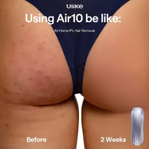 clinical before-after ad showing bumpy skin on the left labelled Before and clear skin on the right labelled 2 Weeks with a hair removal device in the corner